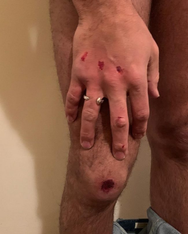 Taray Carey shows his injuries after the Uber journey