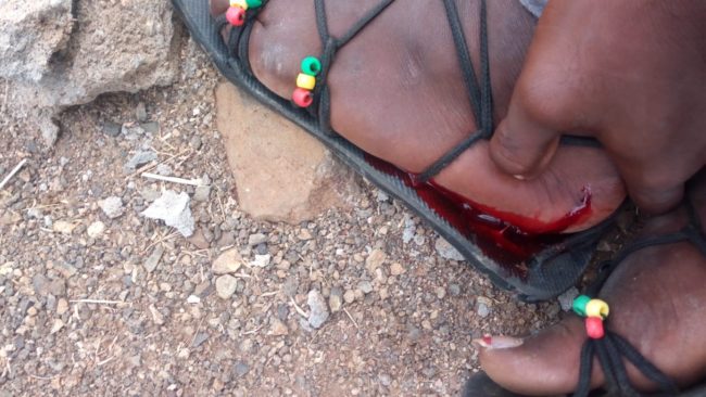 An LGBT+ activist injured with bloody foot in Kakuma Kenya 