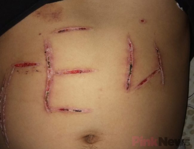 A picture of the injury suffered by a bisexual man in Kyrgyzstan.